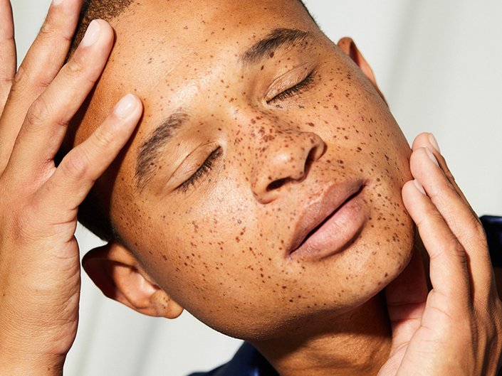 Person with freckles closing their eyes and holding their head with their hands